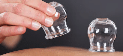 what is cupping