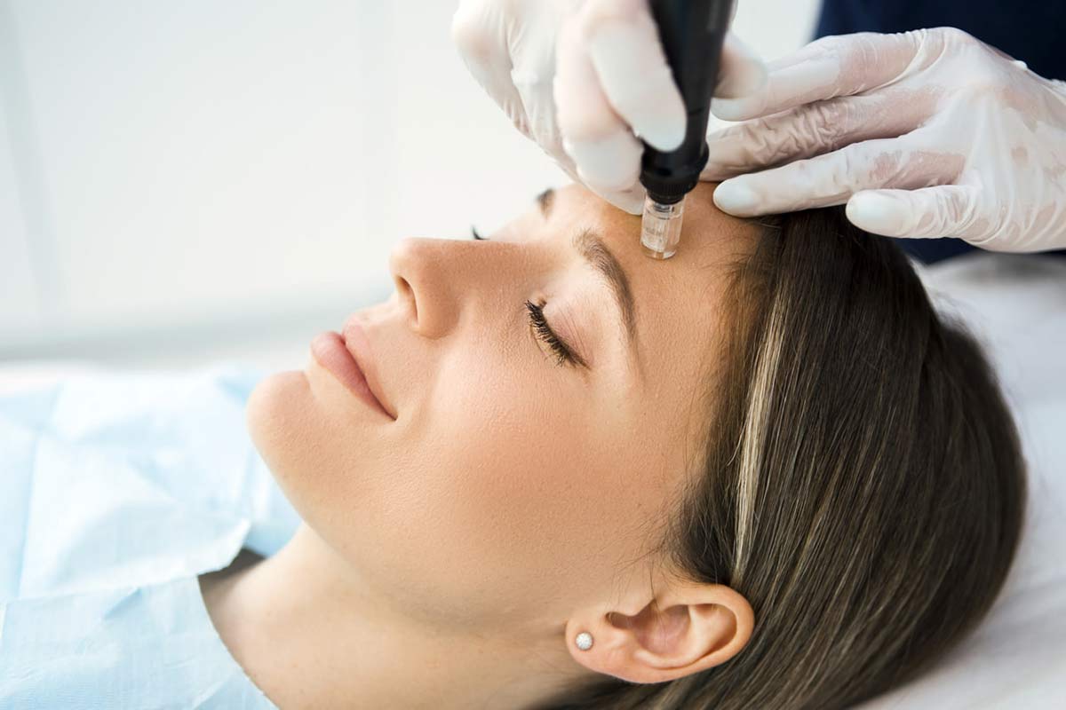 Microneedling Acupuncture in Portland