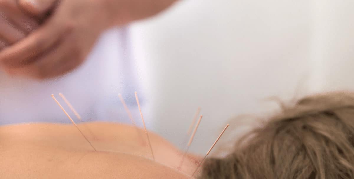 Stay in the game with acupuncture
